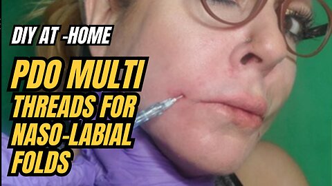 DIY AT HOME PDO MULTI THREADS FOR NASO- LABIAL FOLDS
