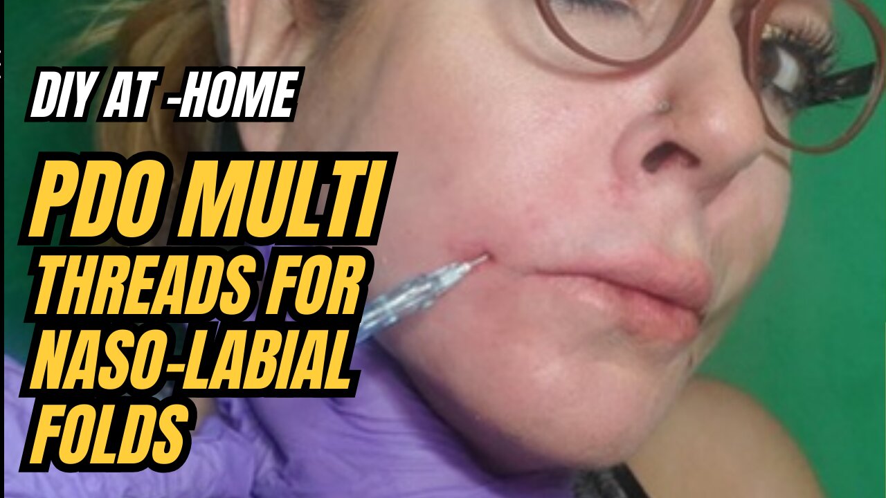 DIY AT HOME PDO MULTI THREADS FOR NASO- LABIAL FOLDS