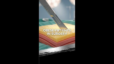Obese Patients in Surgery