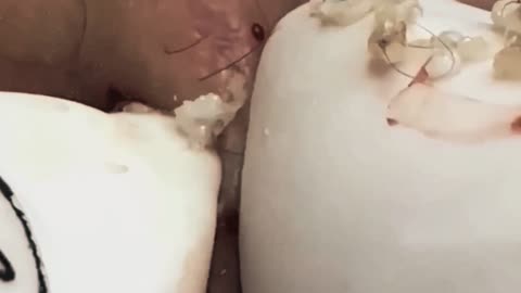 Squeezing spots and blackheads youtube #1