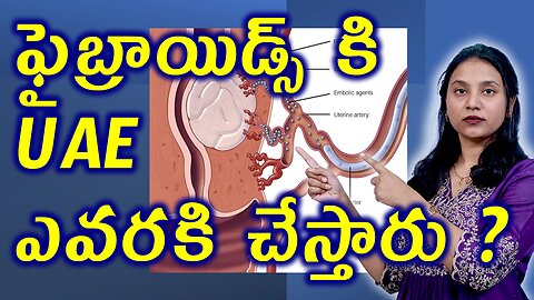 ఫైబ్రాయిడ్స్ కి UAE ఎవరికి చేస్తారు? Conditions of Fibroids Uterine Artery Blocking or Embolizationo