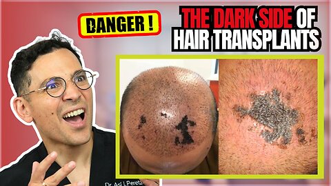Are Hair Transplants Permanent? Doctor Explains the Truth | Dr. Asi Peretz