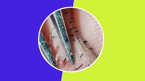 Blackhead removal with tweezers video (ASMR) #1