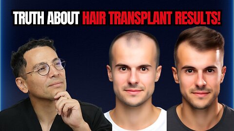 How Long Does a Hair Transplant Take to Show Results?
