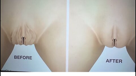 Treatment Labial Lips Rejuvenate Vaginal Filler ❤️ Meamo labs Jeunetique Deep | Meamoshop 🥰🙌💕