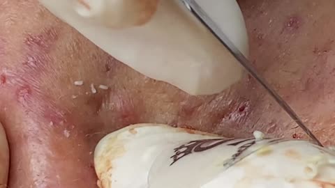 Satisfying Pimple Pops and Deep Blackhead Extractions 225
