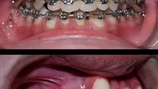 Incredible: Braces for crowded teeth #braces #orthodontist #dentistry #dentist