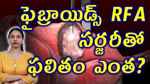 ఫైబ్రాయిడ్స్ RFA సర్జరీ తో ఫలితం ఎంత? RFA (Radiofrequency Ablation) or Lap-RFA Surgery for Fibroids