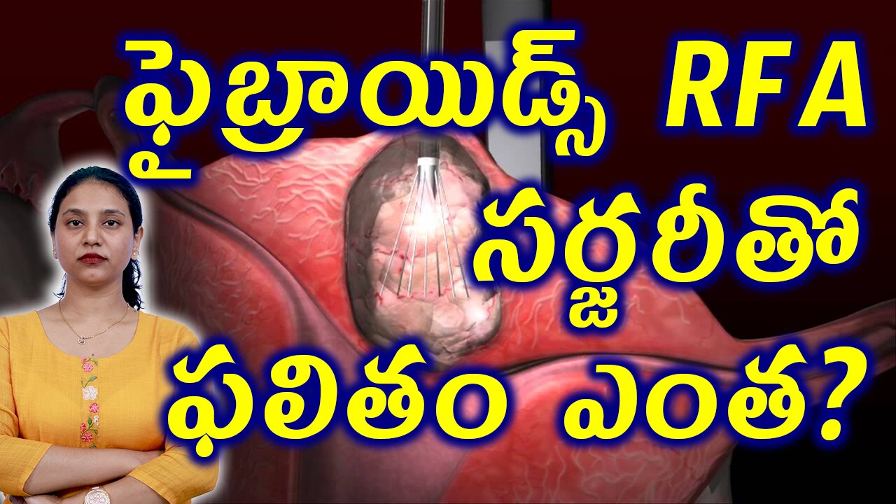 ఫైబ్రాయిడ్స్ RFA సర్జరీ తో ఫలితం ఎంత? RFA (Radiofrequency Ablation) or Lap-RFA Surgery for Fibroids