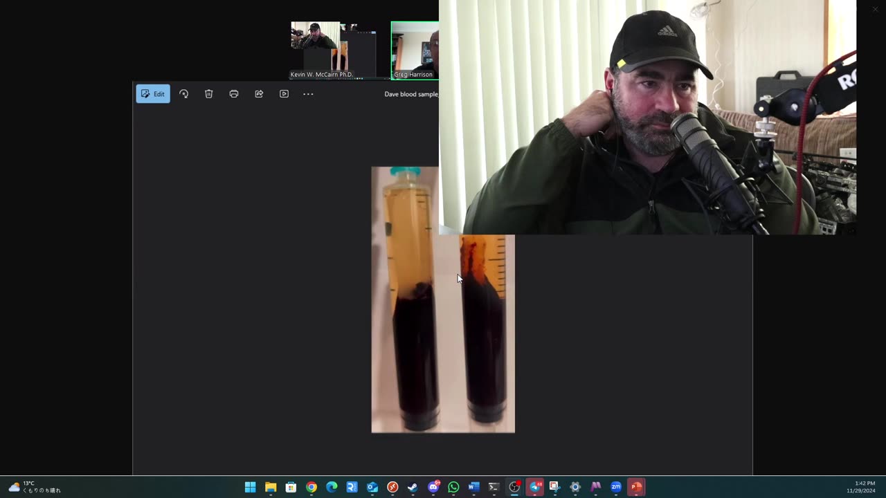 (CLIP) High Amyloidogenicity in Post-Mortem 'Calamari' Clots, Blood Analysis