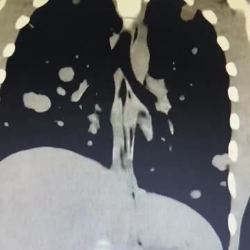 DR. BEN MARBLE: "WE'VE GOT A YOUNG 21-YEAR-OLD WITH NEW ONSET TURBO CANCER ALL OVER HIS BODY."