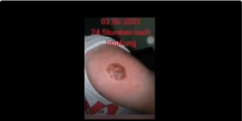 This lady's arm is literally splitting open where she got her Pfizer shots!
