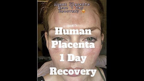 HUMAN PLACENTA 1 DAY RECOVERY- Catch this on Acecosm’s 1 day sale. 😍