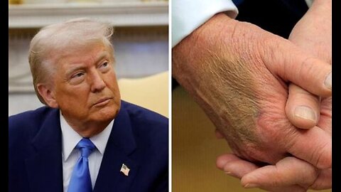 Trump Diagnosed with Chronic Venous Insufficiency