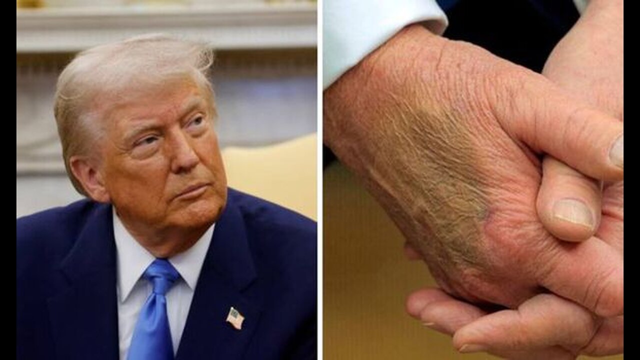 Trump Diagnosed with Chronic Venous Insufficiency