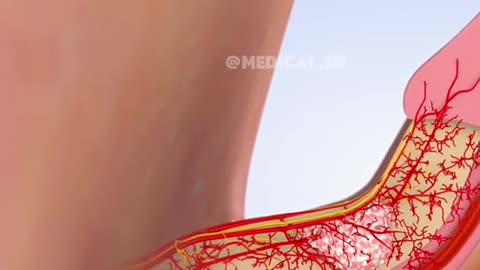 Peyronie’s Disease and its treatment (3D Animation)