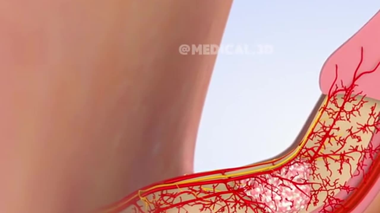 Peyronie’s Disease and its treatment (3D Animation)
