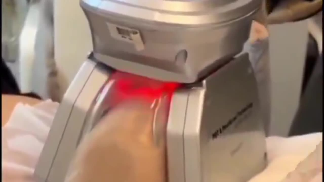 Abdominal fat removal with cryolipolysis. OMG