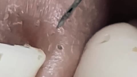 New satisfying blackhead removal #1