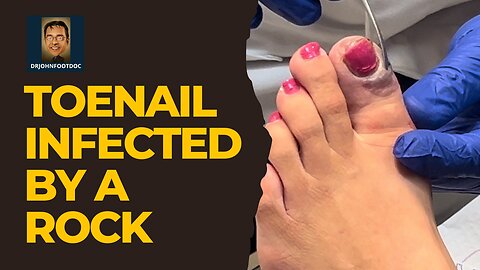 Severely Infected Toe from a ROCK!