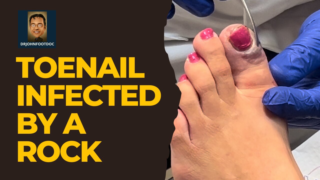 Severely Infected Toe from a ROCK!