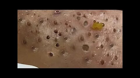 Blackheads Removal & Pimple Popper Cystic Acne Extraction 441