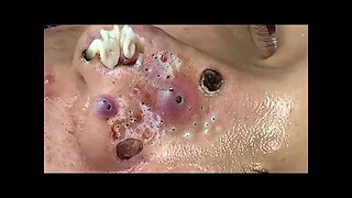 Relaxing Blackheads Removal Big Cystic Acne Extraction Whiteheads Pimple Popping 02