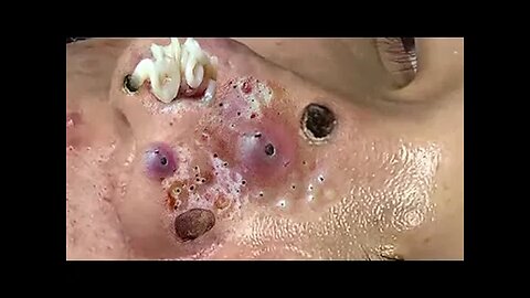 Relaxing Blackheads Removal Big Cystic Acne Extraction Whiteheads Pimple Popping 02