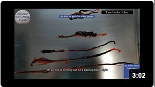 Horrifying BLACK GOO Removed from Beating Heart of Vaxxed