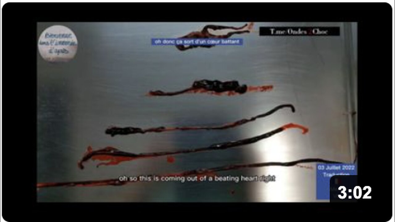 Horrifying BLACK GOO Removed from Beating Heart of Vaxxed
