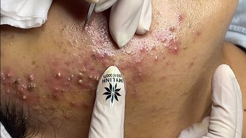 Acne treatment