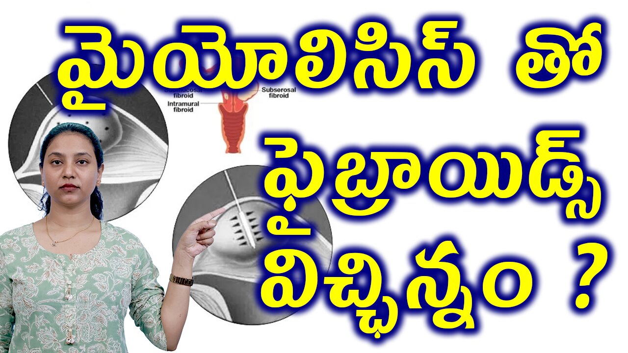 మైయోలిసిస్ తో ఫైబ్రాయిడ్స్ విచ్ఛిన్నం? | Best Painless Faibroids Removal No Surgery Laser Myolysis