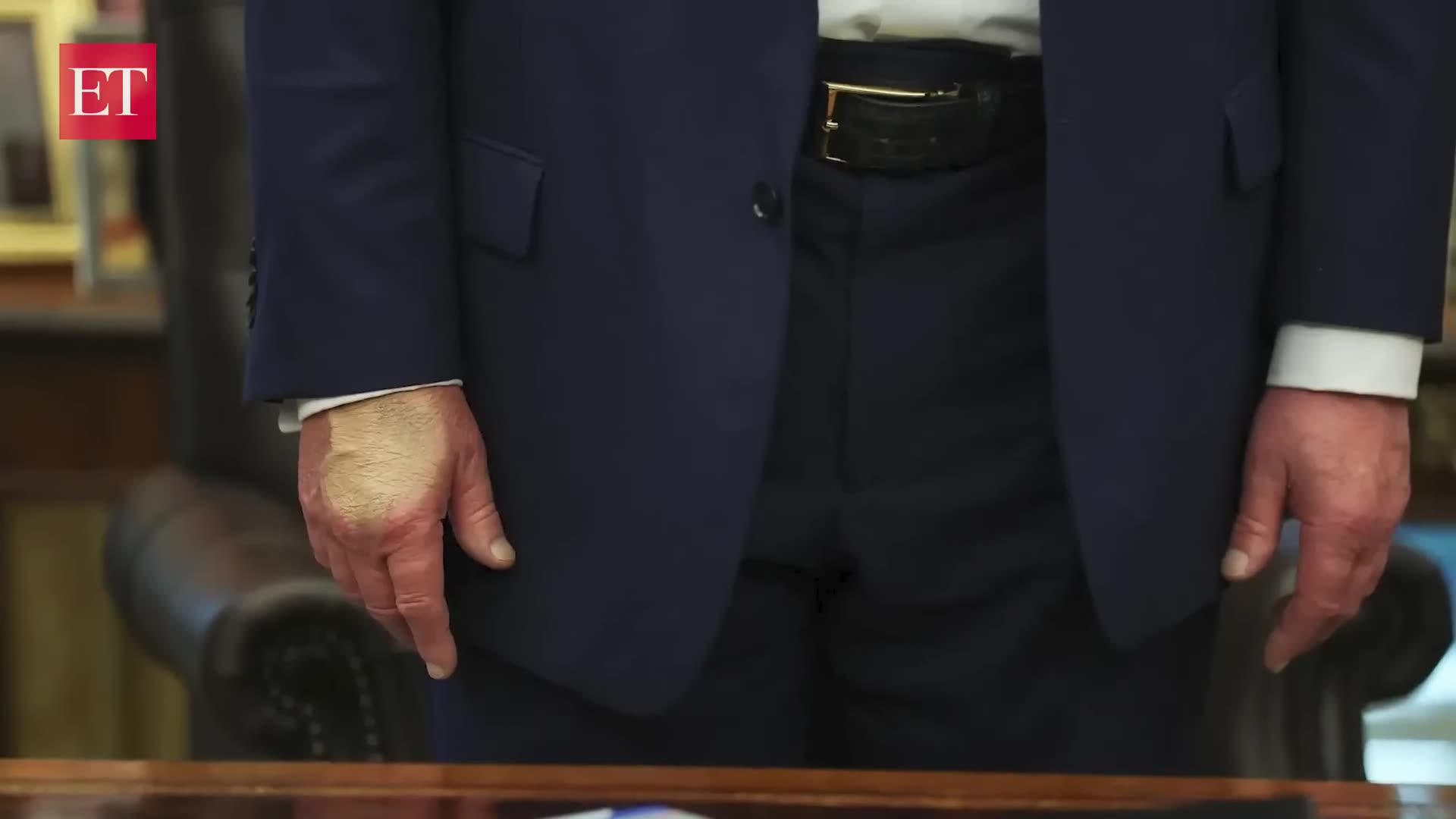 BREAKING ⛔️Is Trump hiding illness? Viral photos show his hand with makeup sparking fresh health concerns