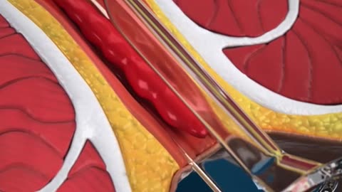 Laser Piles Treatment Surgery 3D Animation - Hemorrhoids Removal Surgery