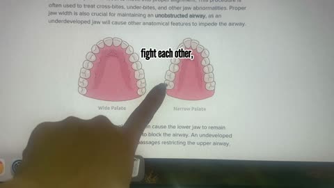 Straighten Teeth Without Braces!