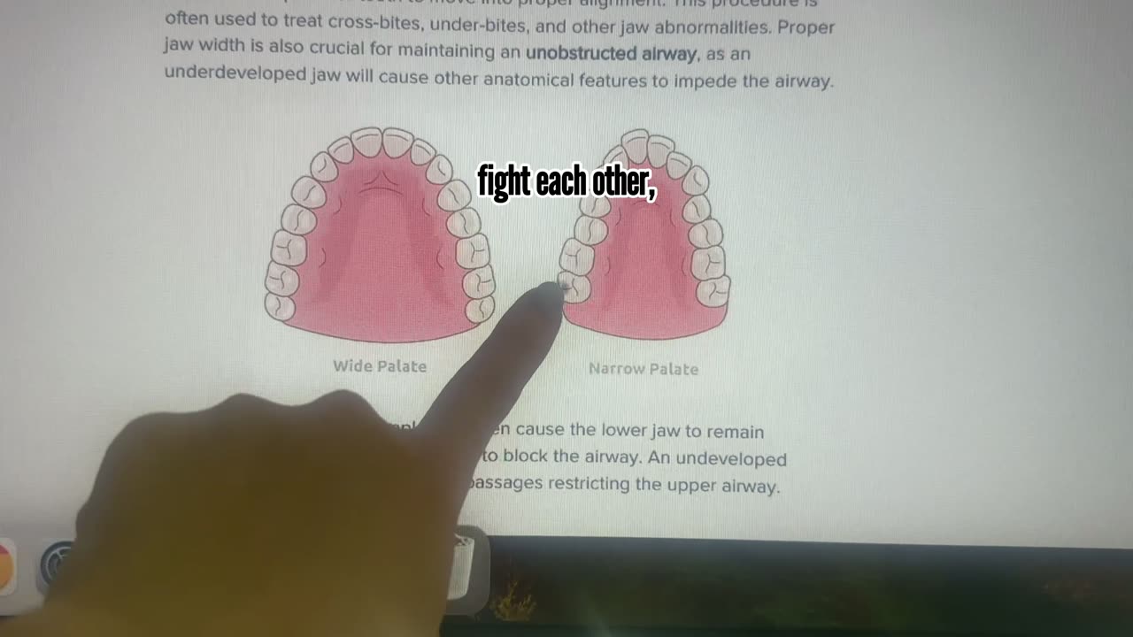Straighten Teeth Without Braces!