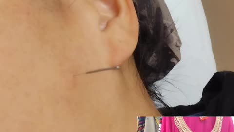 Dry needling