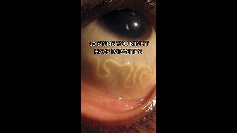 10 signs you might have parasites #parasites