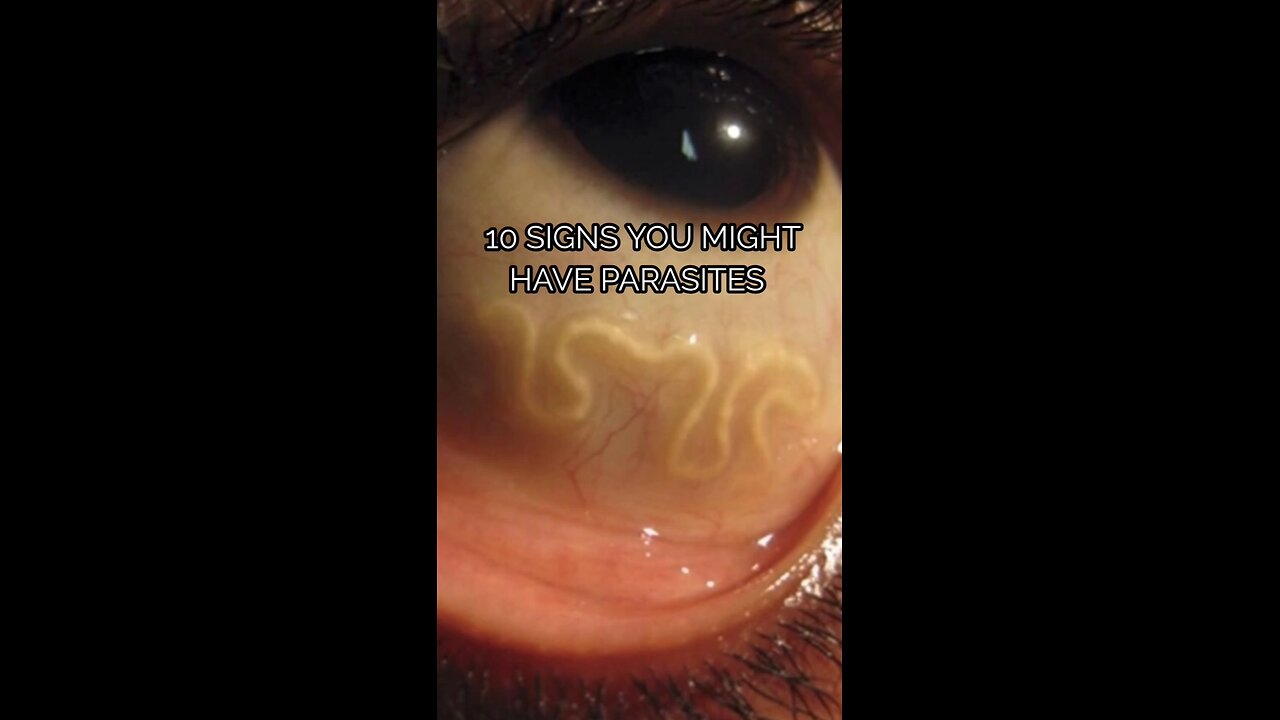 10 signs you might have parasites #parasites