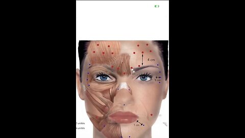 Botox Chart #beauty Shop GlowFace- Meamoshop - Celmade - Estaderma Code LOIS ❤️❤️❤️