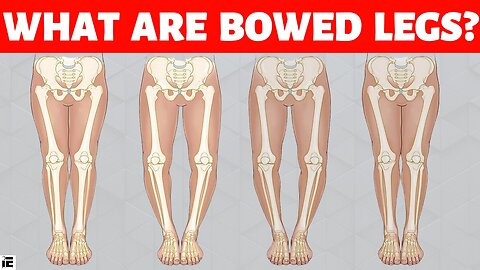 Why Do Some Kids Have Bowed Legs? | Everything You Need To Know