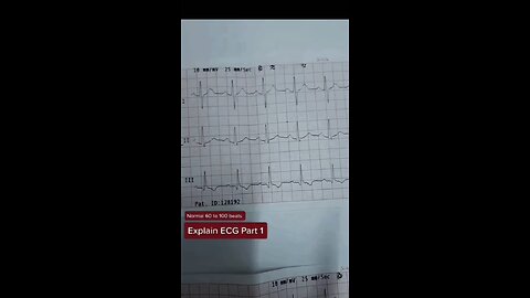 ECG