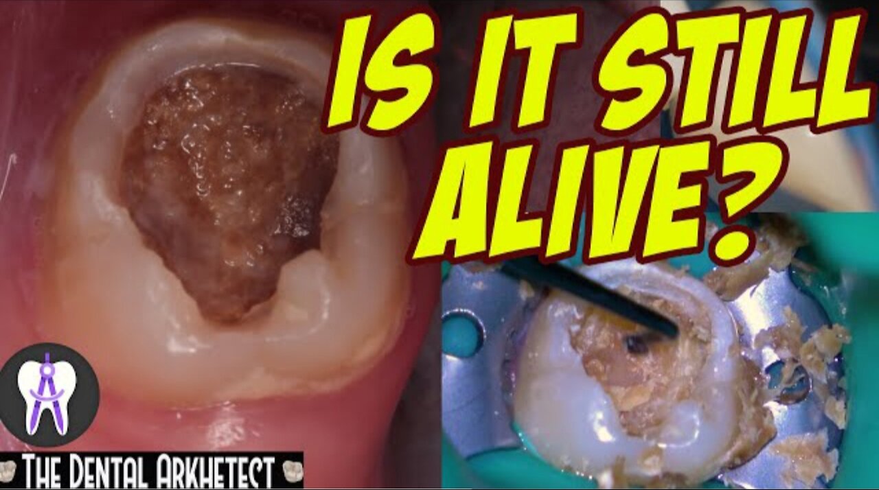 AMAZING Save of A Tooth w/ A Very BIG and DEEP Cavity