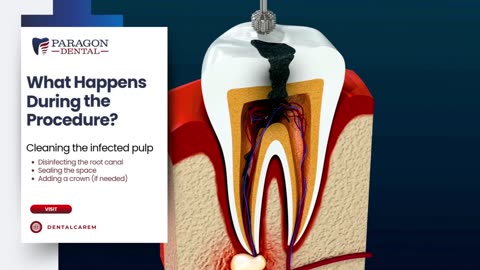 Root Canal Therapy for Teenagers
