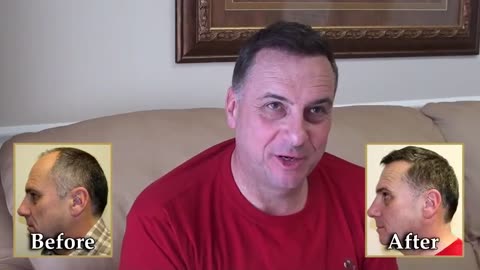 Dr. Brett Bolton Delivers Outstanding Hair Restoration Results for International Patient