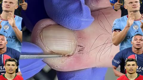 Cleaning is very needed! Home Service Pedicure Series #ingrowntoenail #toenails #pedicure (8)