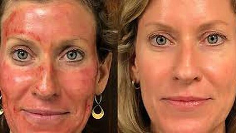 "Unveiling the Shocking Effects of the Popular Satanic Vampire Facial Trend"