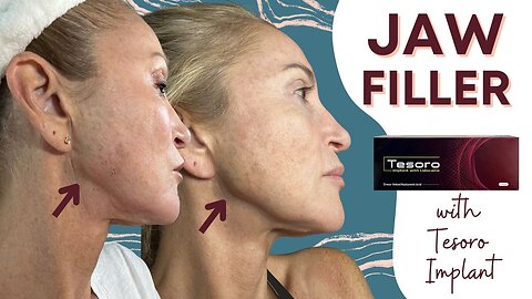 DIY Filler for a Snatched Jawline!