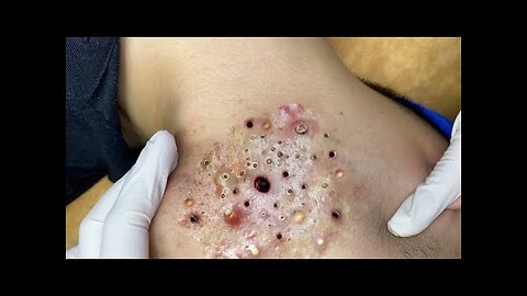 Relaxing Skincare blackhead removal