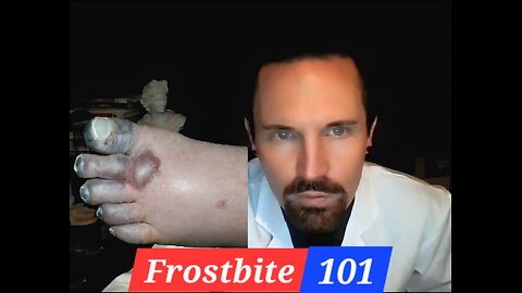 Frost Bite 101 The Basics